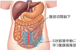低位前方切除術