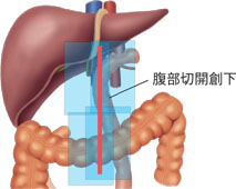 胃全摘術