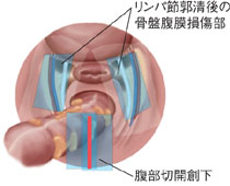 広汎子宮全摘術