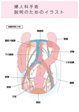 婦人科手術説明のためのイラスト
