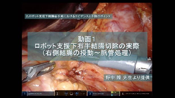 ロボット支援下右半結腸切除の実際（右側結腸の授動～脈管処理）