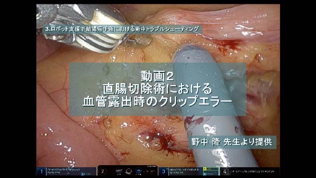 直腸切除術における血管露出時のクリップエラー