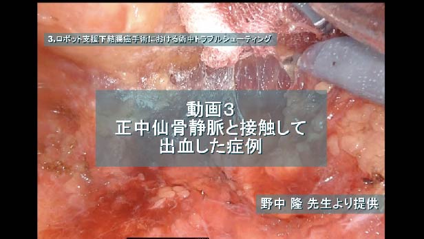 正中仙骨静脈と接触して出血した症例