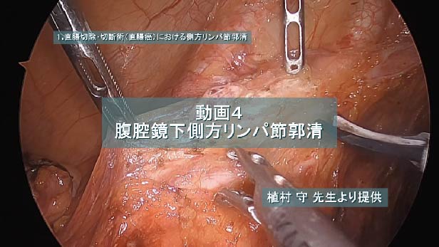 腹腔鏡下側方リンパ節郭清