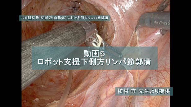 ロボット支援下側方リンパ節郭清