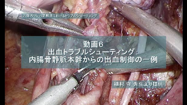 出血トラブルシューティング：内腸骨静脈本幹からの出血制御の一例