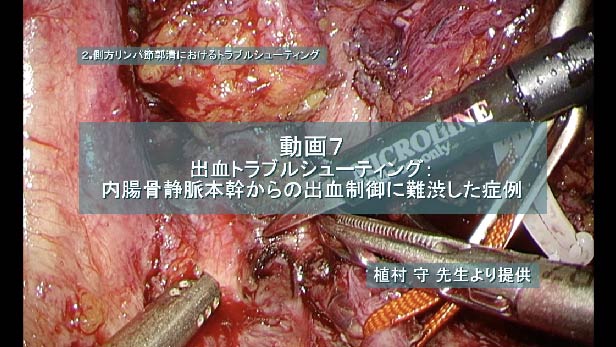 出血トラブルシューティング：内腸骨静脈本幹からの出血制御に難渋した症例