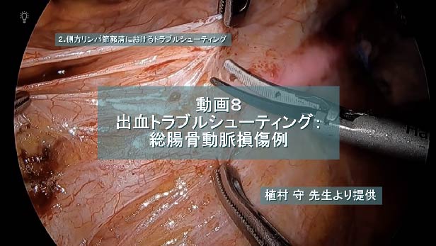 出血トラブルシューティング：総腸骨動脈損傷例
