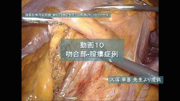 吻合部-膣瘻症例