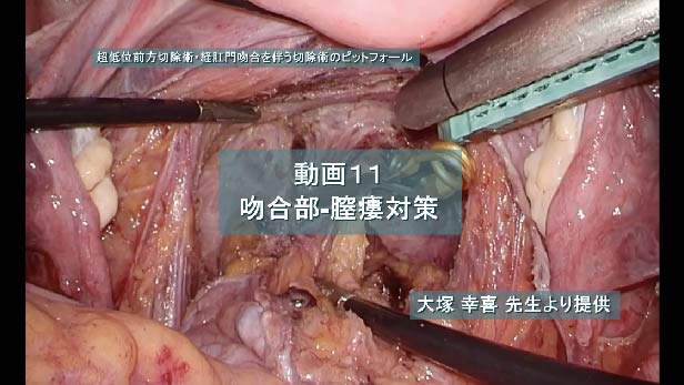 吻合部-膣瘻対策